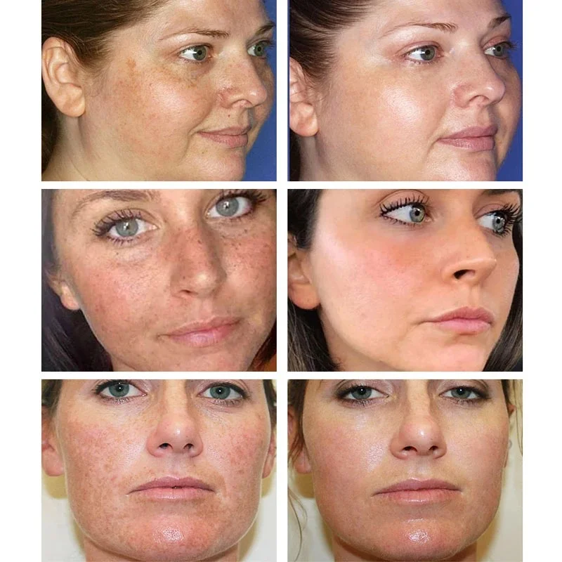 Effective Whitening Freckles C - Licorice Root Sticks review and price